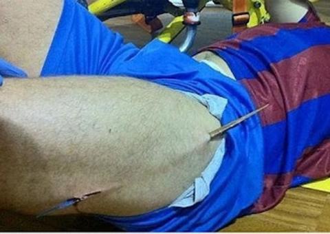 Atleta tem coxa perfurada durante jogo